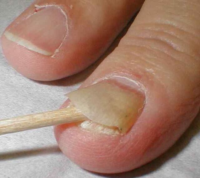 desquamazione dell'unghia con fungo dell'unghia del piede