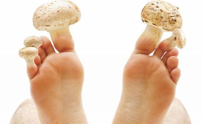 cause, sintomi e trattamento del fungo del piede