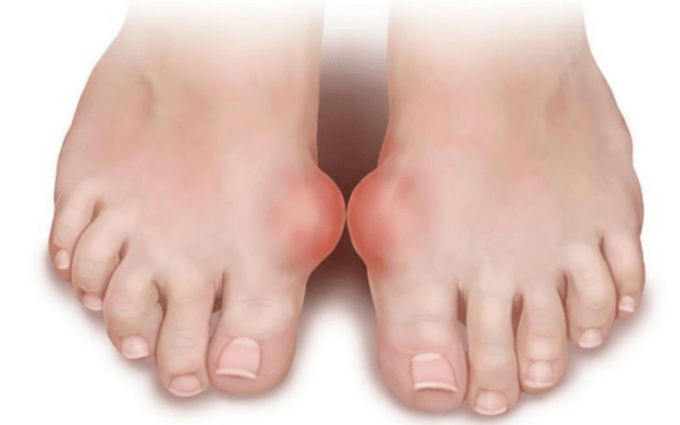 deformità del piede come causa della comparsa di funghi sulle gambe