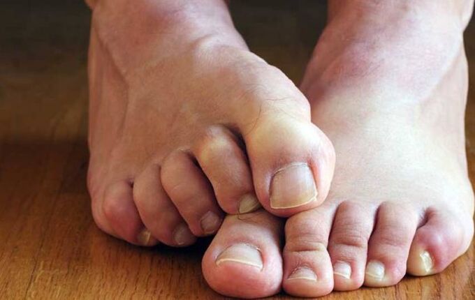 sintomi di funghi squamosi sui piedi