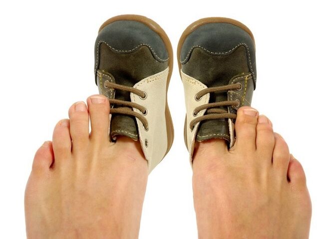 scarpe strette come causa di funghi tra le dita