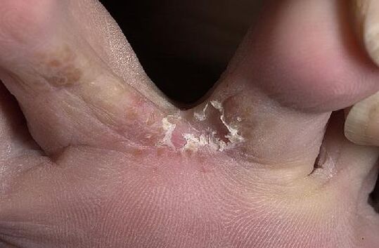 dita dei piedi colpite da funghi