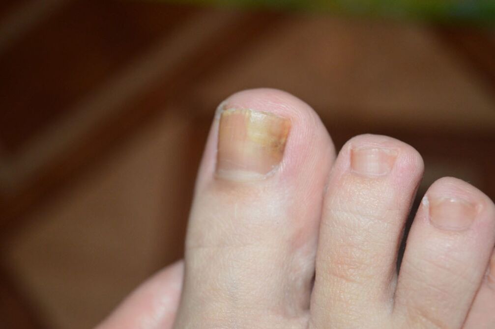 La fase iniziale del fungo dell'unghia del piede