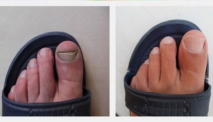 unghie dei piedi prima e dopo aver trattato il fungo con aceto di mele