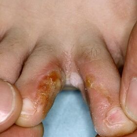 Segni di funghi tra le dita dei piedi