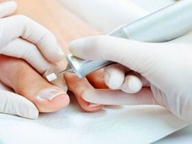 Pedicure terapeutico per il fungo dell'unghia del piede