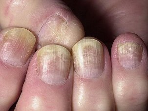 funghi sulle unghie